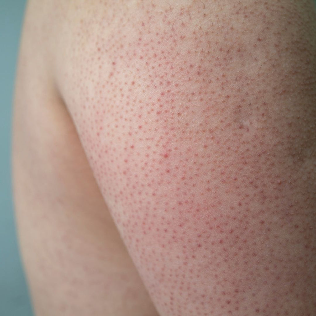 How to reduce the strawberry skin or keratosis pilaris effect?