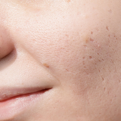 Enlarged pores: which facial routine to adopt?